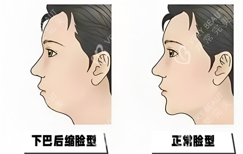 下巴后縮與正常臉型對(duì)比動(dòng)畫圖