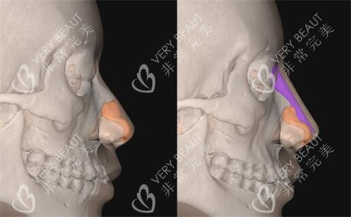 FITme3D鼻假体模拟隆鼻展示