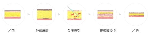 吸脂过程图解