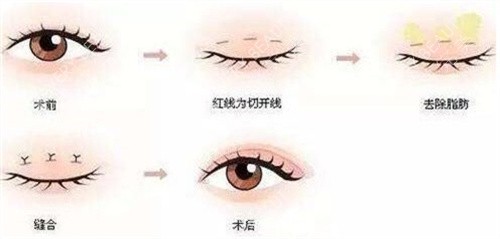 韩式双眼皮