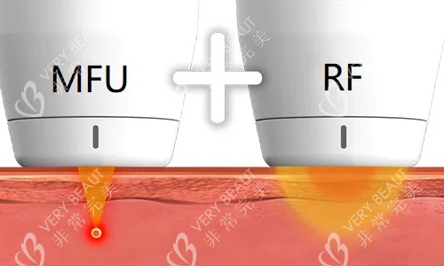 V-RO提升激光