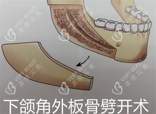 下颌角外板劈开术