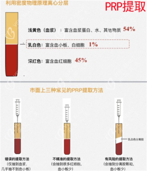 丽芙莎高潮针的原理介绍