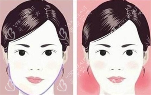 面部咬肌宣传图