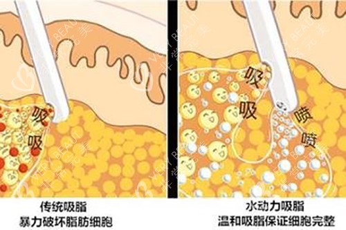 吸脂示意图