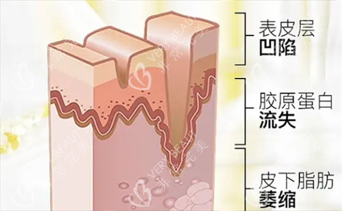 皮肤皱纹皮下组织剖面图