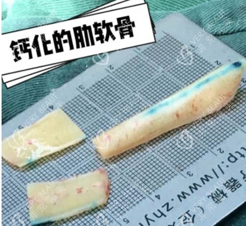 钙化的肋软骨