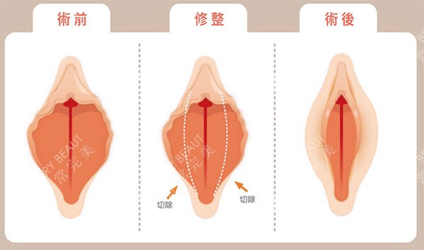 外阴唇切除术前术后