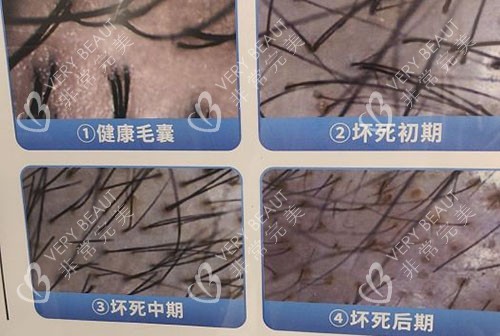 武汉仁爱医院植发科毛囊检测实拍