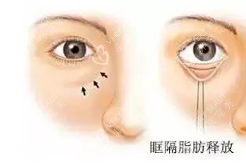 内切法眶隔脂肪释放