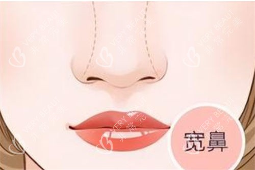 宽鼻形态展示图