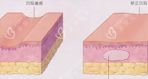 皮肤表面凹凸不平的动画展示