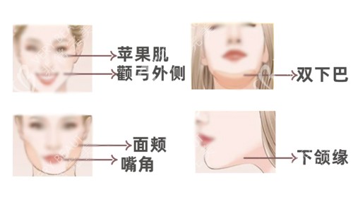 面部溶脂适用人群