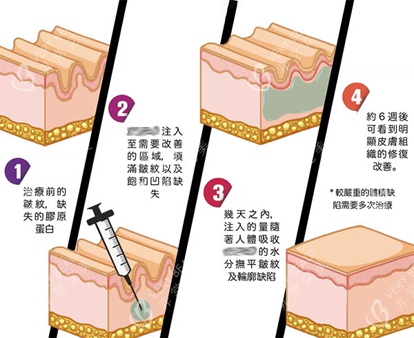 左旋乳酸PLLA清秀针注射照片