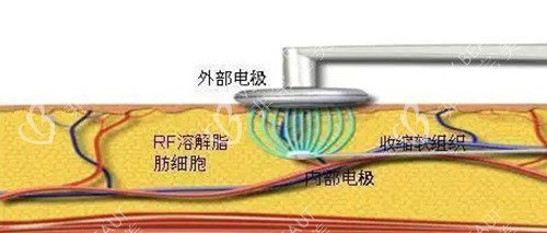 射频溶脂原理