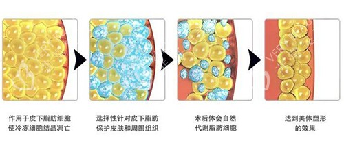 冷冻溶脂