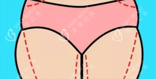 大腿吸脂术前画线展示图