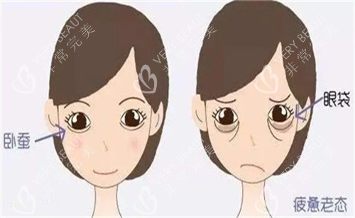 卧蚕手术对比