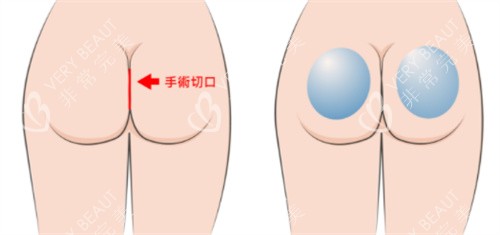 假体丰臀手术切口