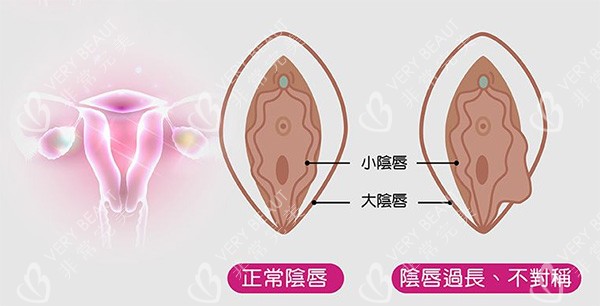 阴唇不对称改善照片
