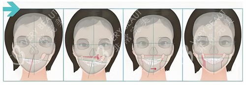 正颌手术手术步骤展示动画图