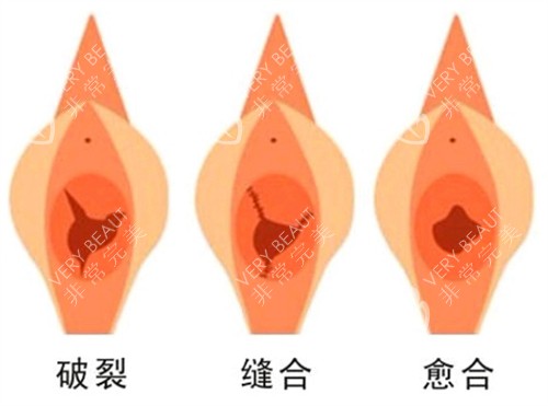 处女膜修复手术前后对比图