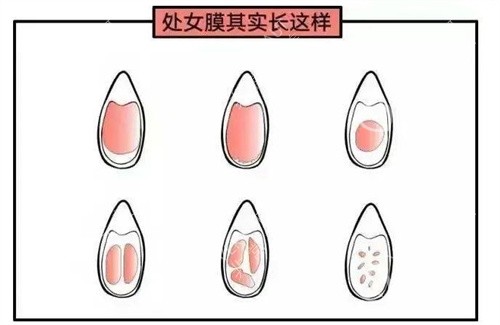 处女膜动画演示图