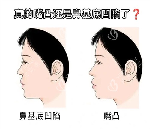 鼻基底凹陷和嘴凸