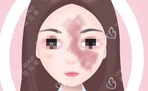 面部胎记示意图