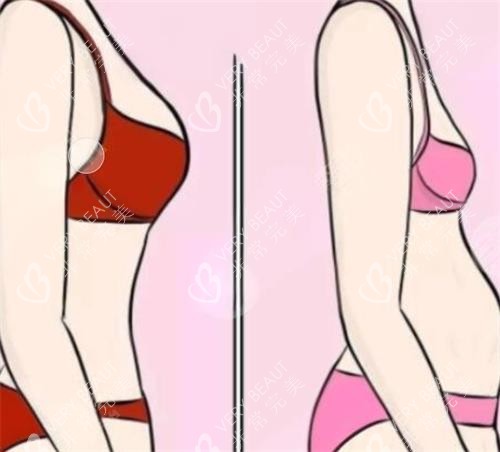 隆胸前后成效对比图