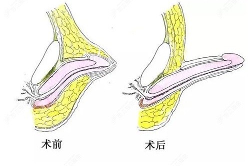 男性私密整形对比图