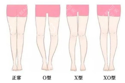 腿型卡通对比图