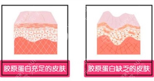 胶原蛋白填充的皮肤对比
