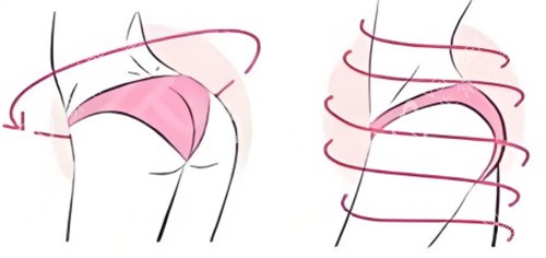 提臀手术呈现图