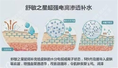 舒敏之星原理