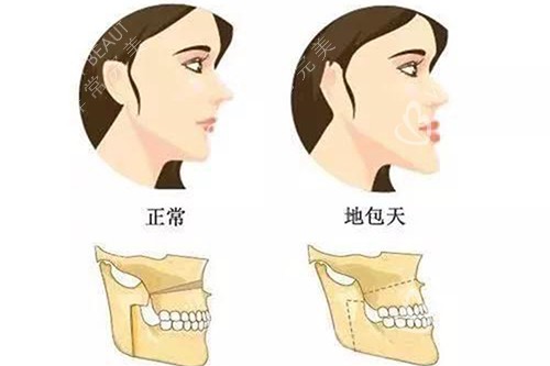 反颌对比卡通示意图
