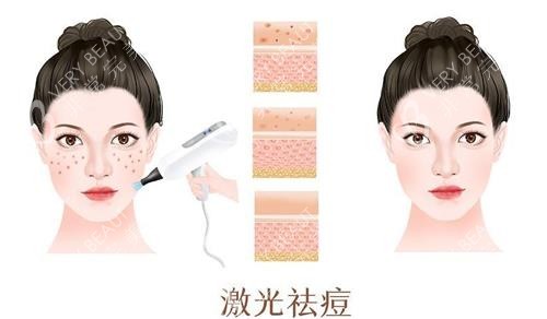 激光祛痘前后的对比