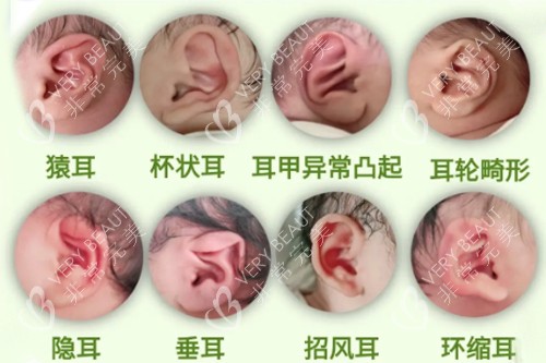 8种耳部畸形图
