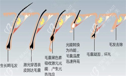 光电仪器脱毛前后对比