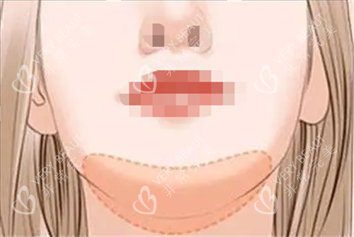 玻尿酸丰下巴部位示意图