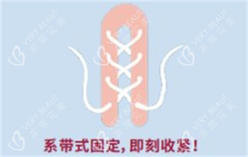 再生阴道紧缩术