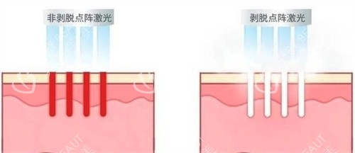 非剥脱和剥脱点阵激光