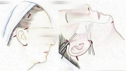 拉皮手术画线手术过程展示图