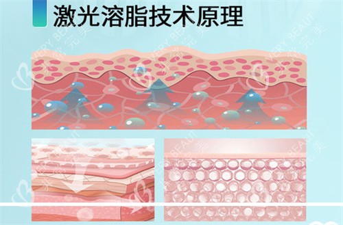 激光溶脂原理