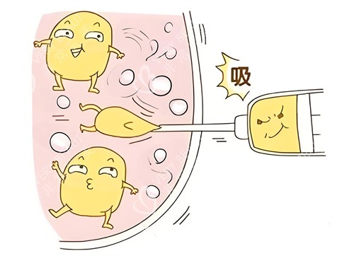 吸脂