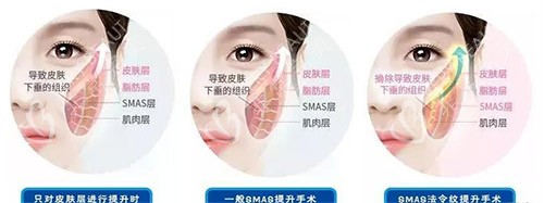 三类拉皮手术方法对比