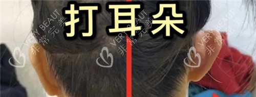 精灵耳注射图