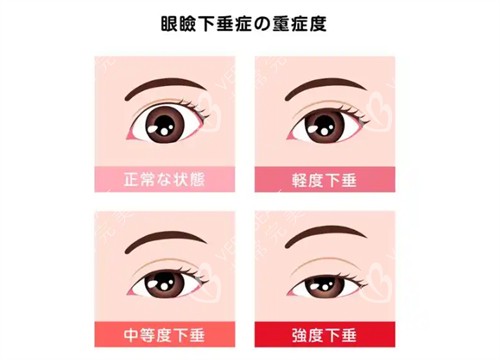 上睑下垂不同程度的样子