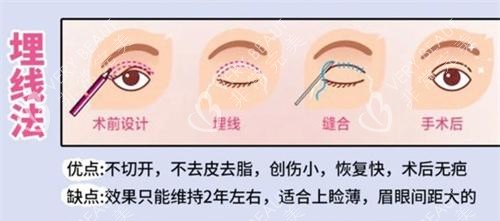 双眼皮手术埋线法动画演示图