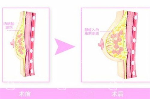 自体脂肪隆胸图片